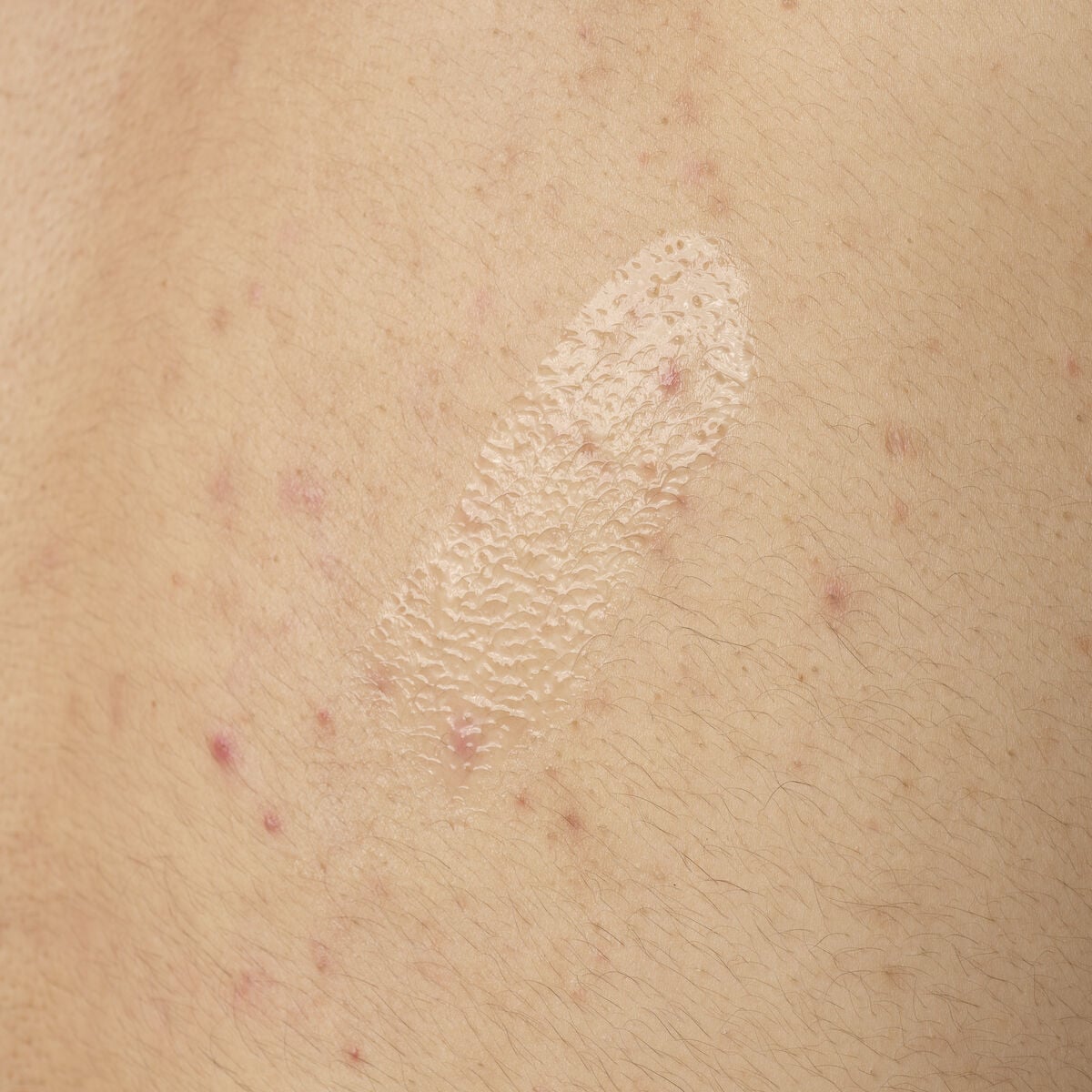 salicylic-acid-0-5-body-serum-x8 ORD-salicylic-acid-05-body-240ml-application.jpg