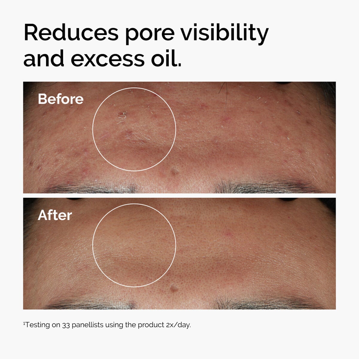 niacinamide-10-zinc-1-k7 ord-niacinamide-zinc-blemish-serum-before-after-pores.jpg