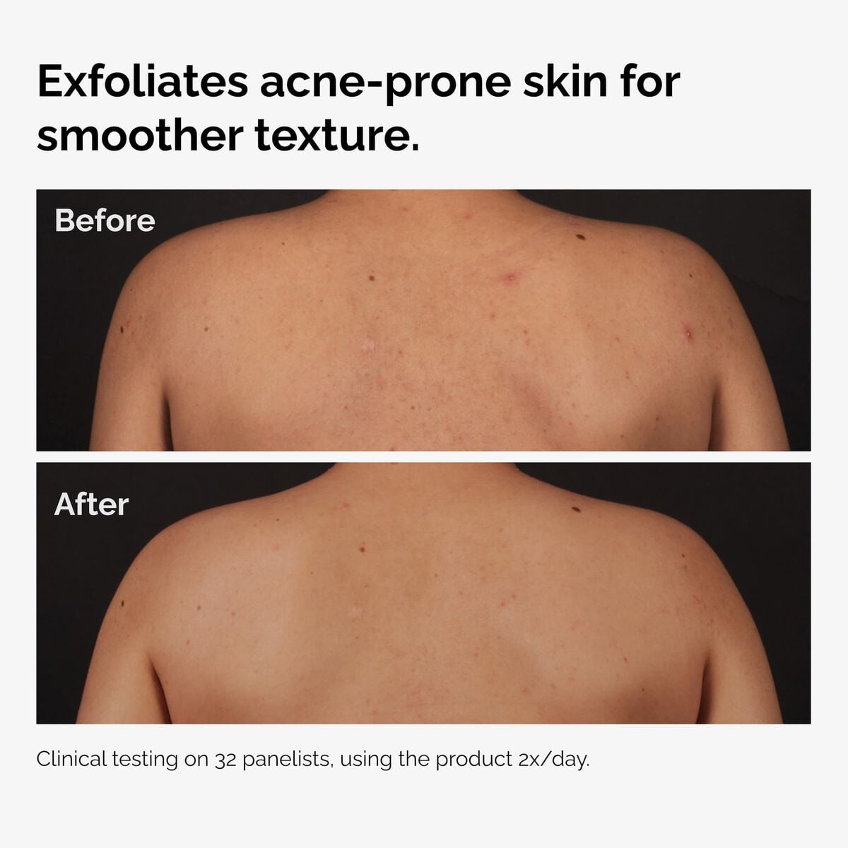 salicylic-acid-0-5-body-serum-x8 ord-salicylic-acid-body-serum-before-after-graphic-NA.jpg
